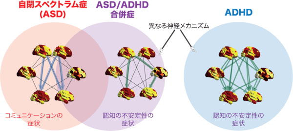 画像：自閉スペクトラム症(ASD)/ADHDの合併症はASDとADHDとを重ね合わせたものではなかった